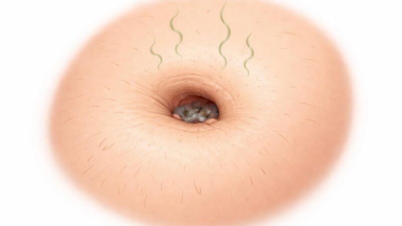 Umbigo Fedido: Causas, Sintomas e Cuidados Essenciais